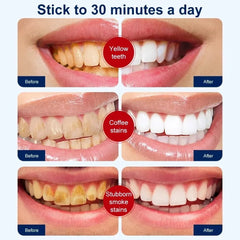 Teeth Whitening Strips – Bright Smile at Home!